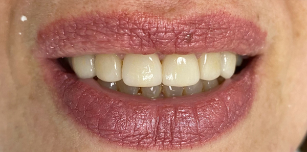 Burlington Veneers | Dental Veneers Burlington, ON | Milton | Waterdown | Blossom Smiles Dental