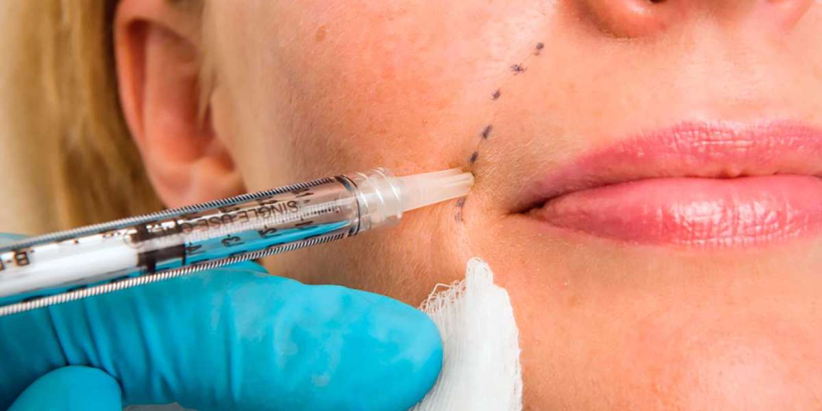 Who is an Ideal Candidate for Dermal Fillers?