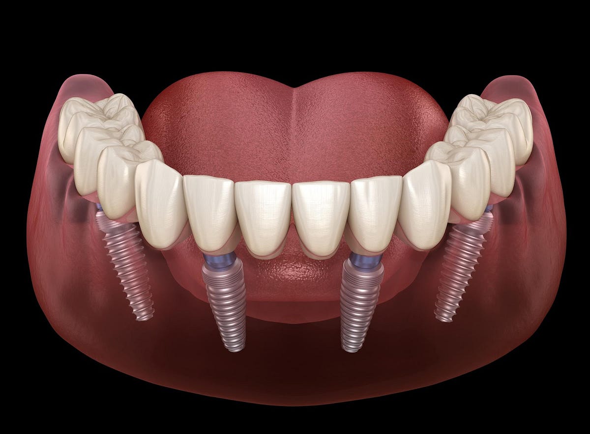 The Lifelong Benefits of All-on-4 Dental Implants