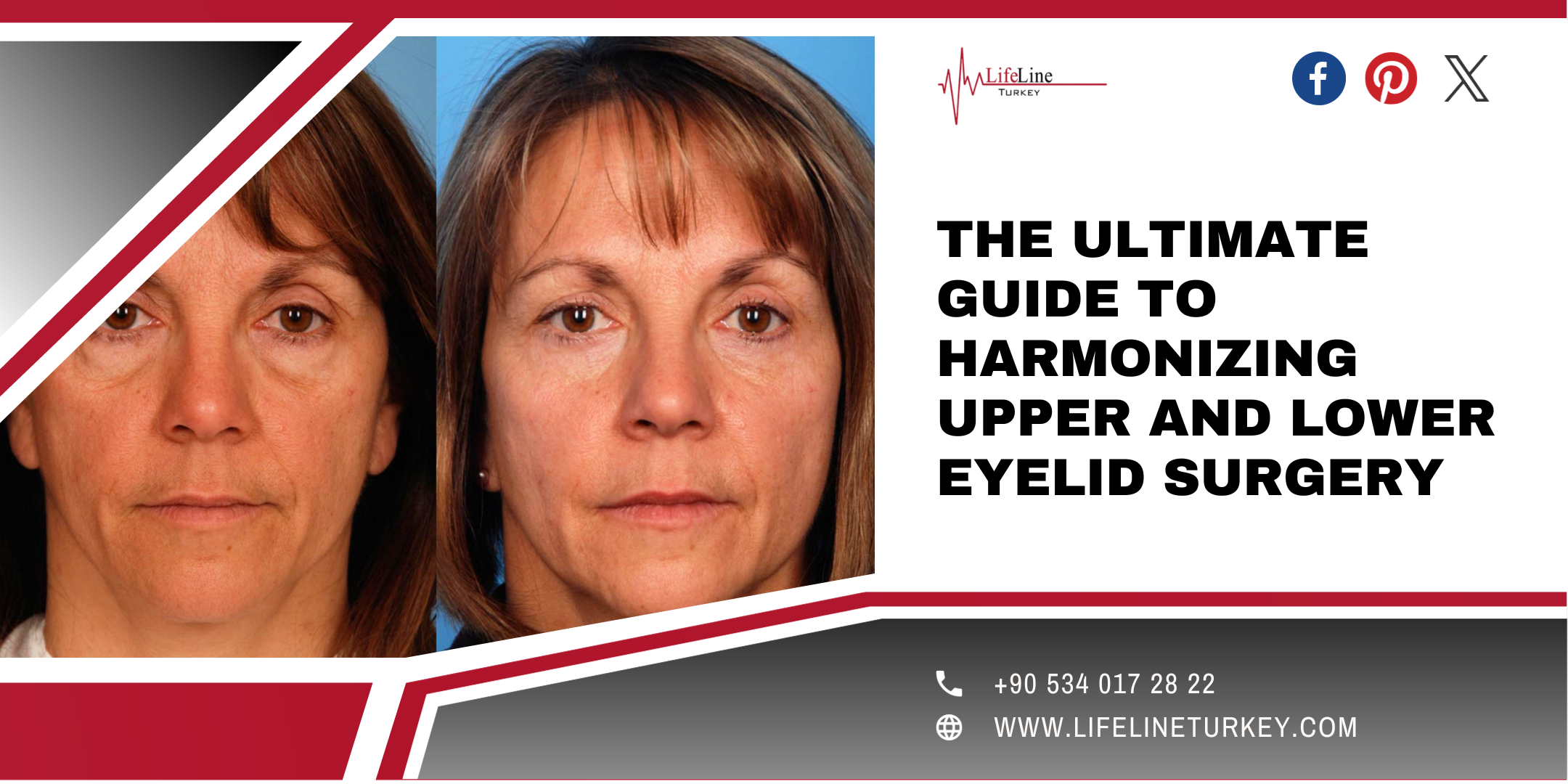 The Ultimate Guide to Harmonizing Upper and Lower Eyelid Surgery
